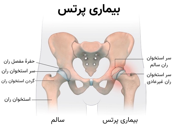 بیماری پرتس