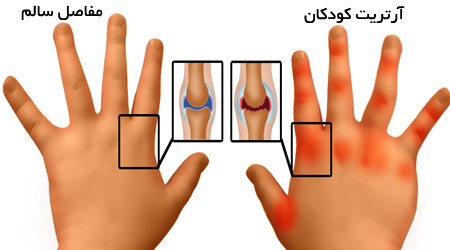علائم آرتریت در کودکان