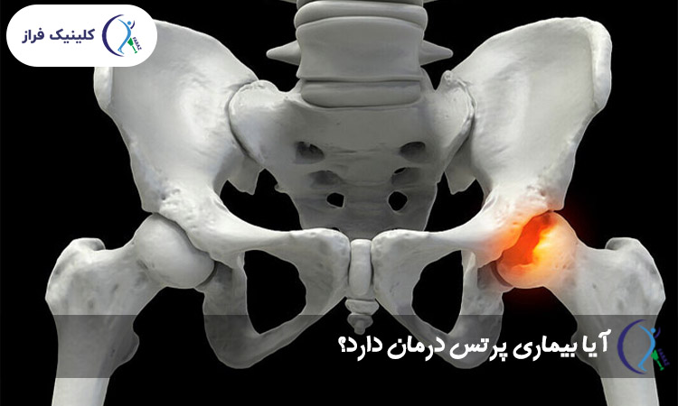 آیا بیماری پرتس درمان دارد؟