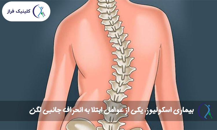بیماری اسکولیوز، یکی از عوامل ابتلا به انحراف جانبی لگن