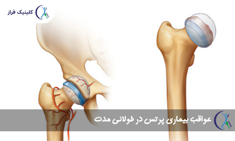عواقب بیماری پرتس در طولانی مدت