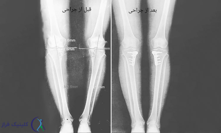 درمان زانو پرانتزی با جراحی