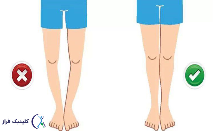 پای پرانتزی و پای عادی