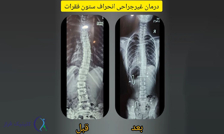 عکس درمان غیر جراحی اسکولیوز در کلینیک فراز