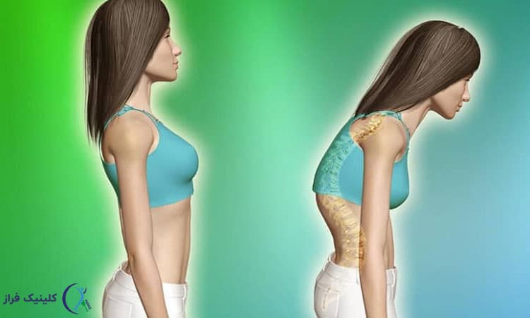 تشخیص کیفوز یا گوژ پشتی