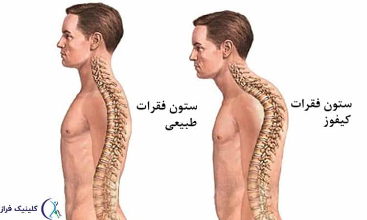 انواع کیفوز