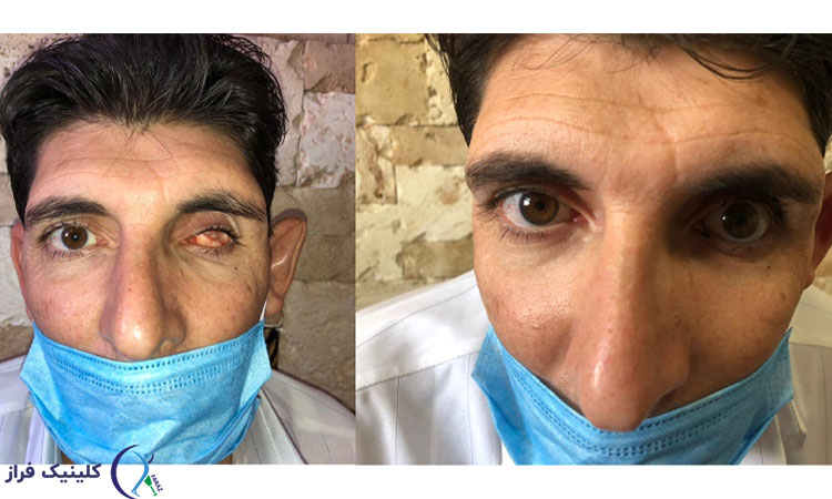 پروتز چشم و اعتماد به نفش دوباره