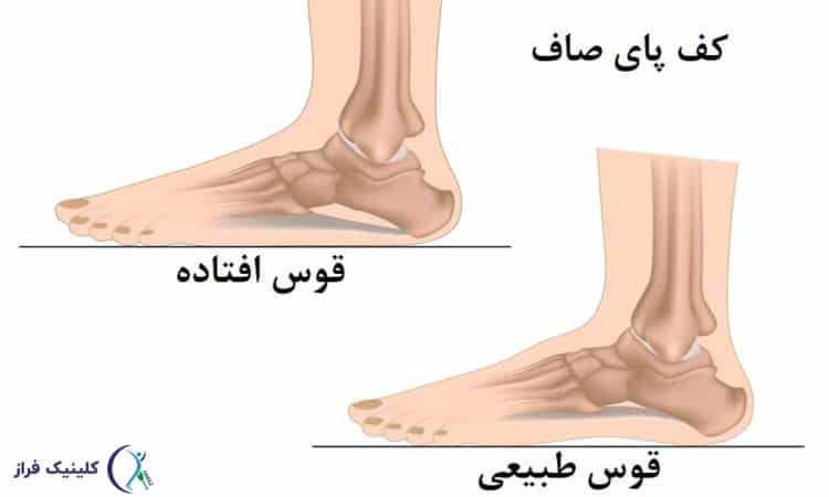 مقایسه کف پای صاف با کف پای معمولی