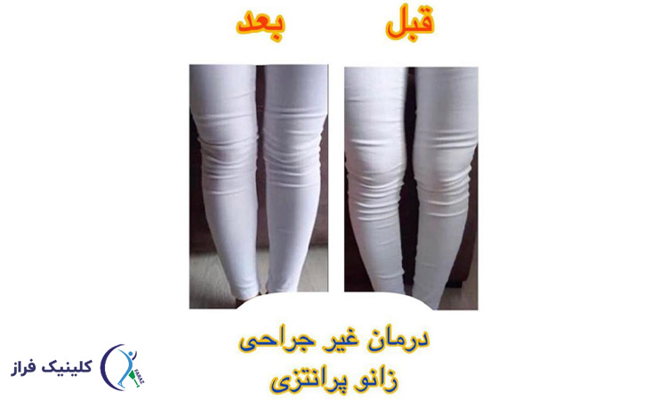 درمان بدون جراحی زانوی پرانتزی