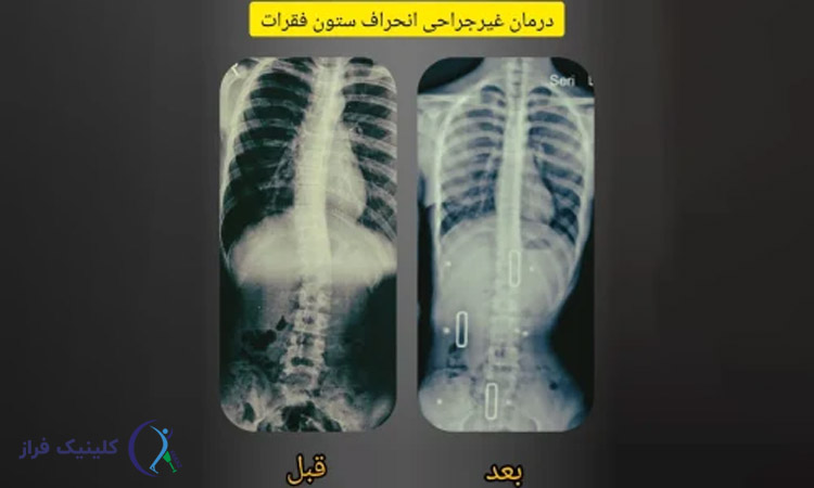 روند درمان غیر جراحی انحراف ستون فقرات