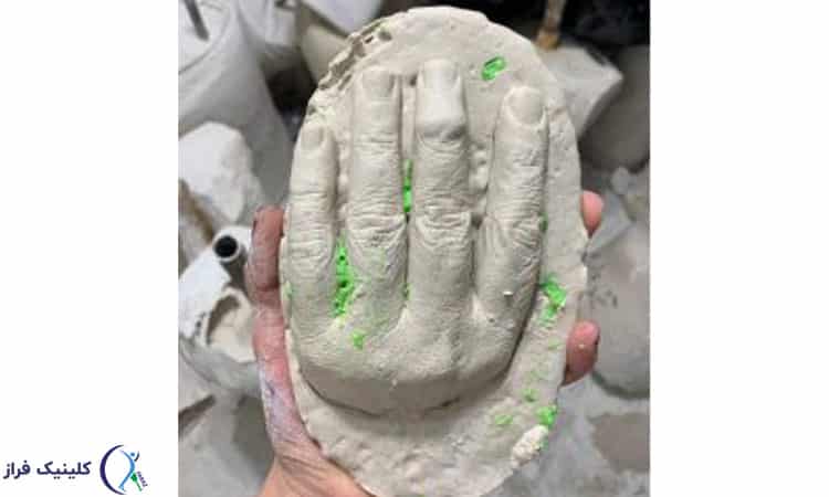 قالب گیری دست مصنوعی