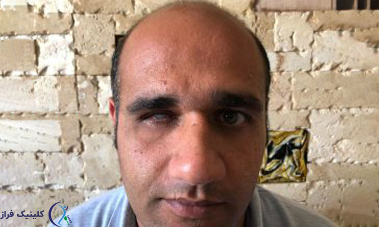 کاندیدای استفاده از چشم مصنوعی