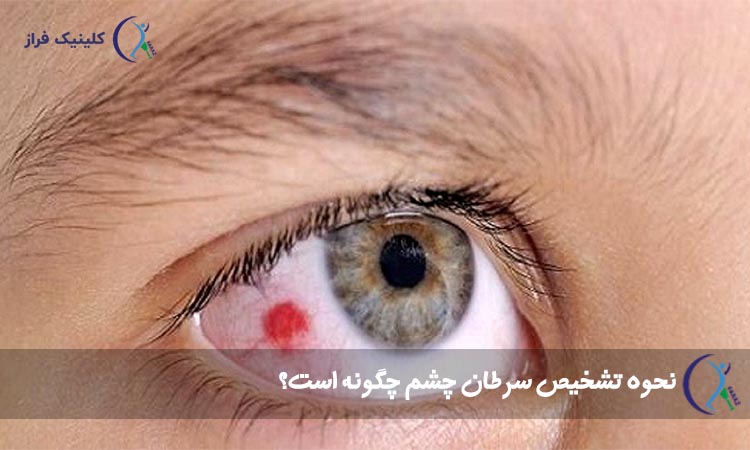 نحوه تشخیص سرطان چشم چگونه است؟