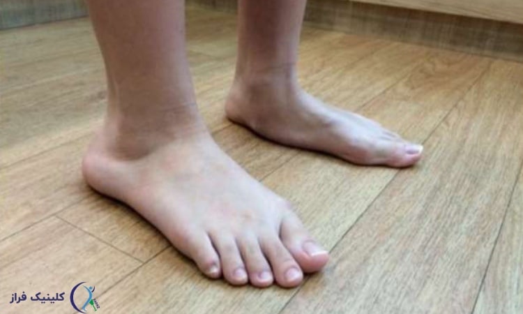 علت کف پای صاف