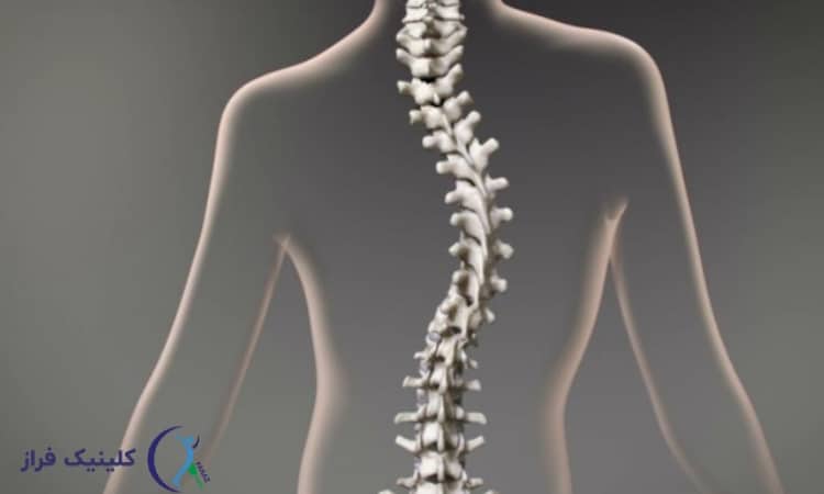 ژنتیک در اسکولیوز