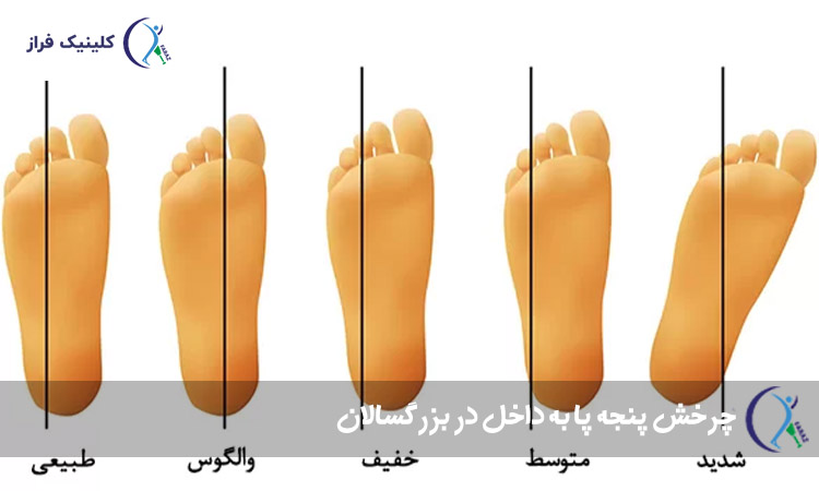 چرخش پنجه پا به داخل در بزرگسالان