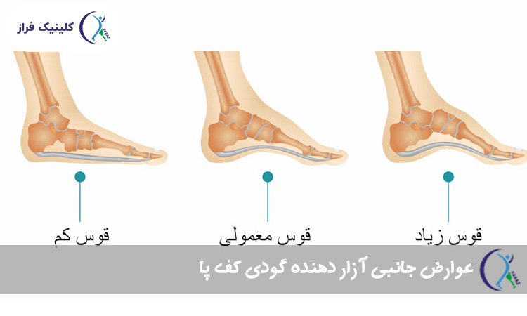 عوارض جانبی آزار دهنده گودی کف پا