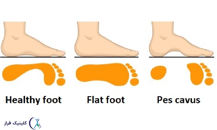 انواع قوس کف پا