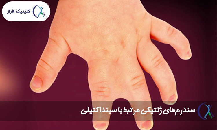 سندرم‌های ژنتیکی مرتبط با سینداکتیلی