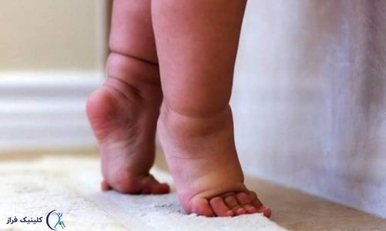 دلایل مشکل در راه رفتن کودک