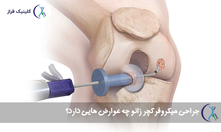 جراحی میکروفرکچر زانو چه عوارض هایی دارد؟
