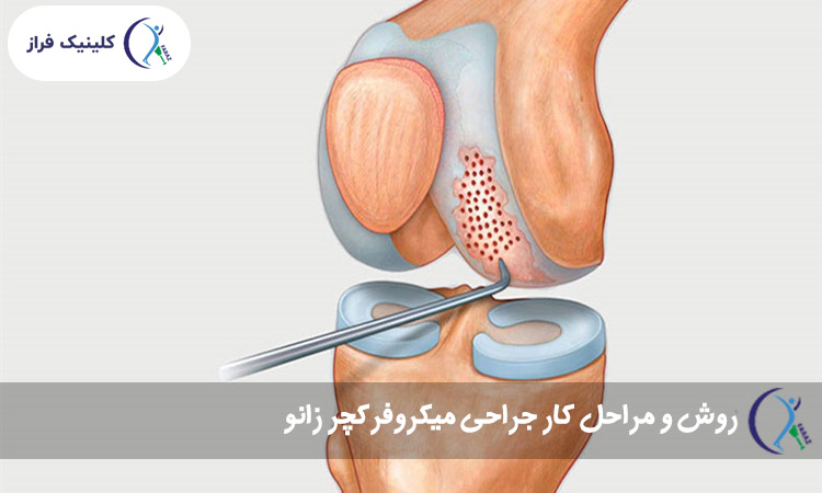 روش و مراحل کار جراحی میکروفرکچر زانو
