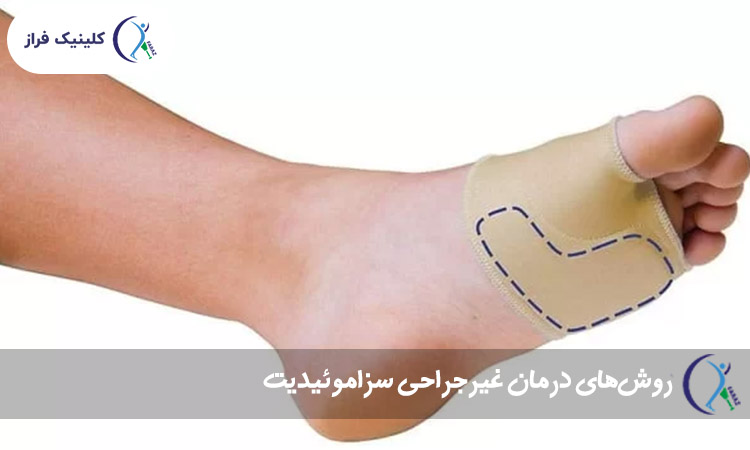 روش‌های درمان غیرجراحی سزاموئیدیت