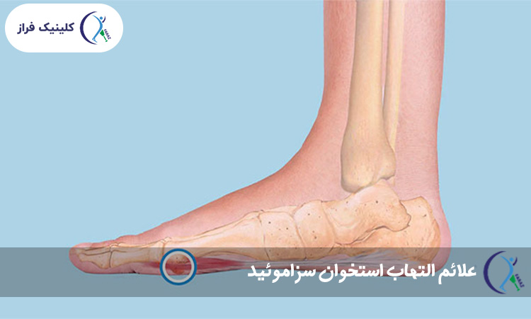 علائم التهاب استخوان سزاموئید