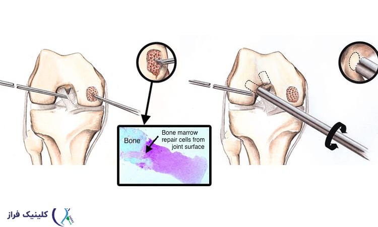جراحی میکروفرکچر زانو یا Microfracture Surgery