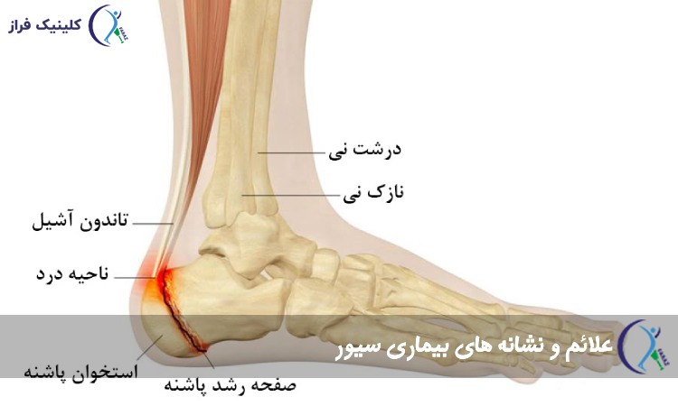 علائم و نشانه های بیماری سیور