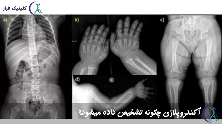 آکندروپلازی چگونه تشخیص داده میشود؟
