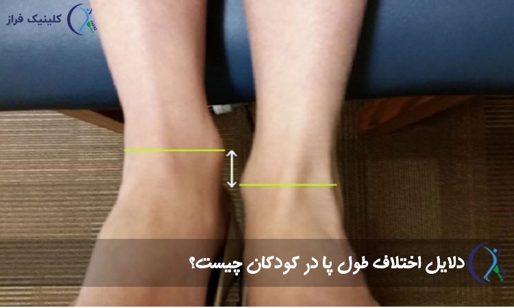 دلایل سندروم پای کوتاه