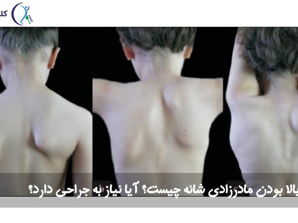 بالا بودن مادرزادی شانه