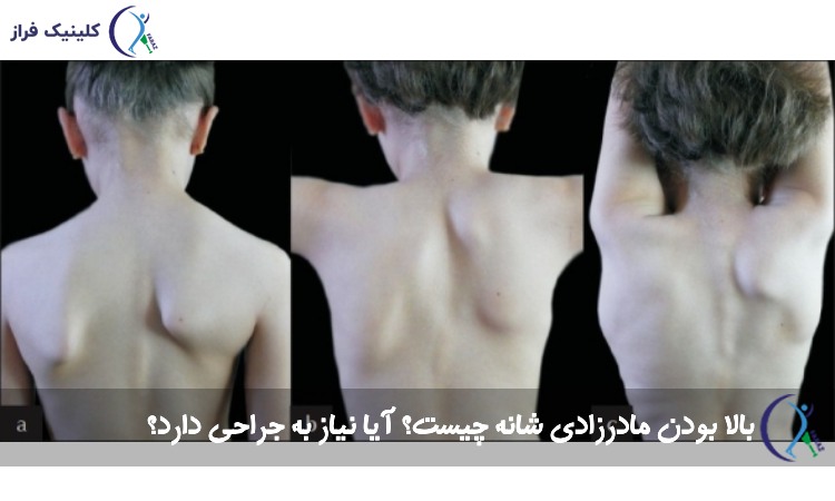 بالا بودن مادرزادی شانه