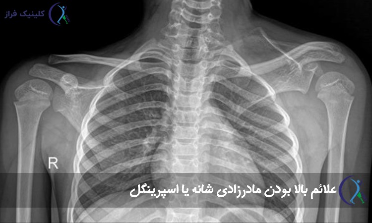 علائم بالا بودن مادرزادی شانه