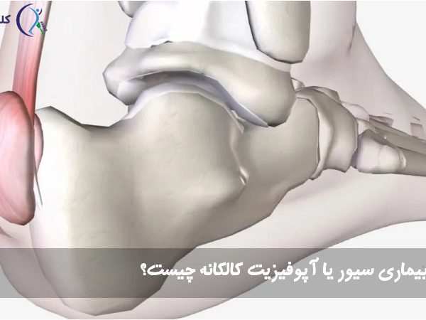 بیماری سیور یا آپوفیزیت کالکانه