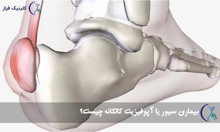 بیماری سیور یا آپوفیزیت کالکانه