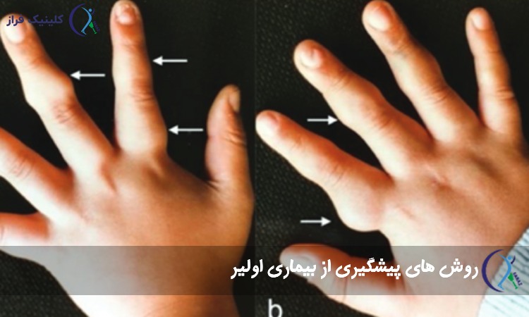 عکس بیماری اولیر