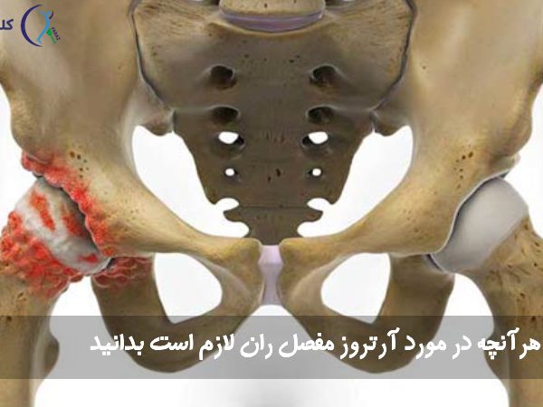 آرتروز مفصل ران