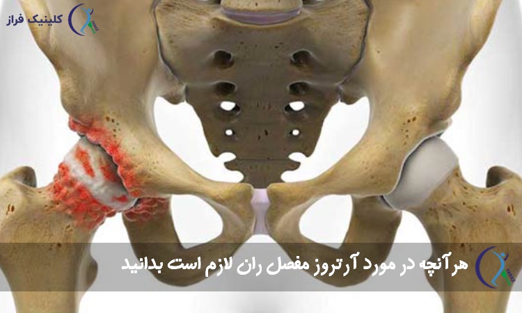 آرتروز مفصل ران