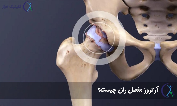 آرتروز مفصل ران چیست؟