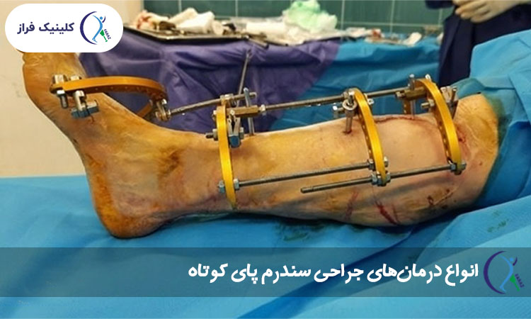 انواع درمان‌های جراحی سندرم پای کوتاه