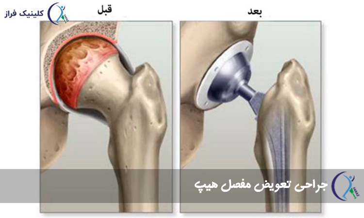 درمان آرتروز ران با جراحی