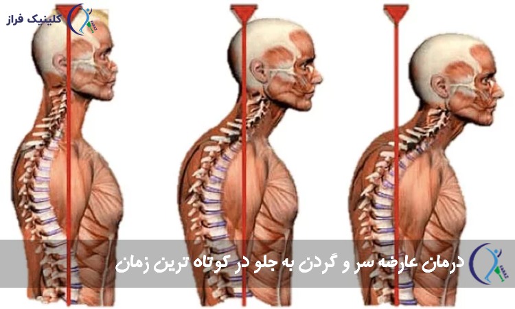 گردن به جلو