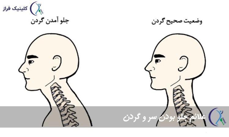 علائم جلو بودن سر و گردن یا FHP