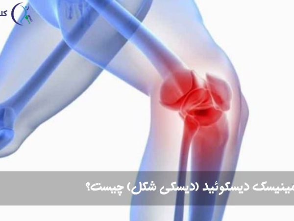 مینیسک دیسکوئید