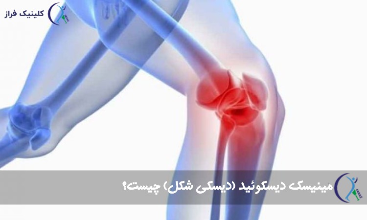 مینیسک دیسکوئید
