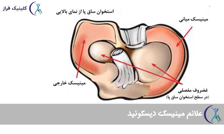 علائم مینیسک دیسکی شکل