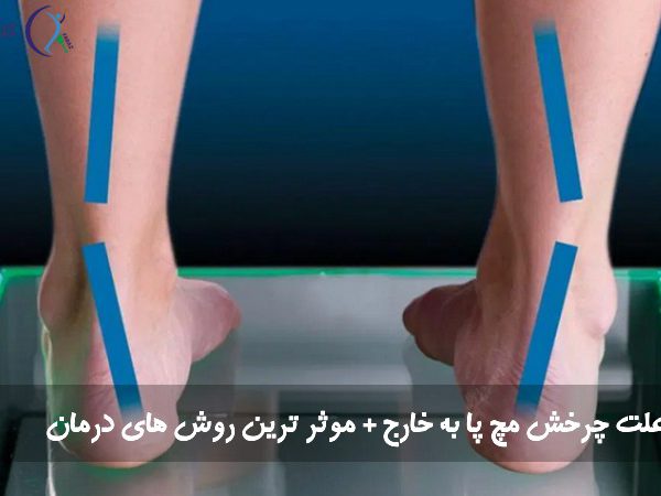 علت چرخش مچ پا به خارج + موثر ترین روش های درمان