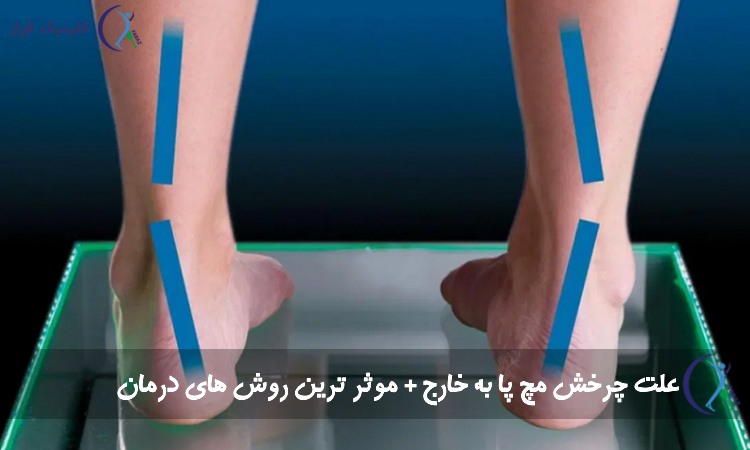علت چرخش مچ پا به خارج + موثر ترین روش های درمان